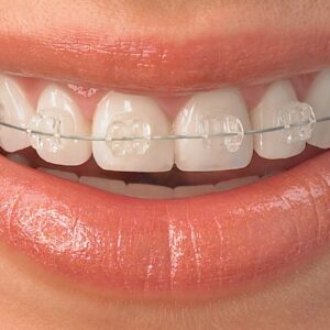ceramic-braces