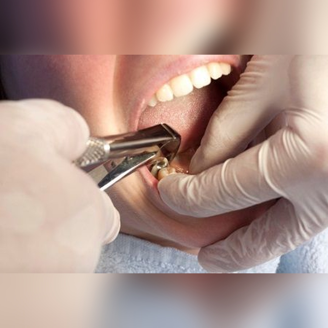 dental extraction_square