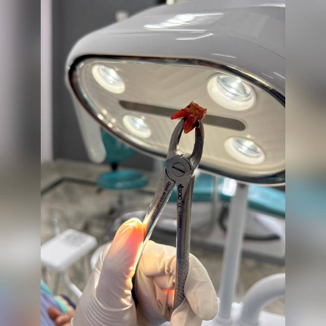 dental extractions_square