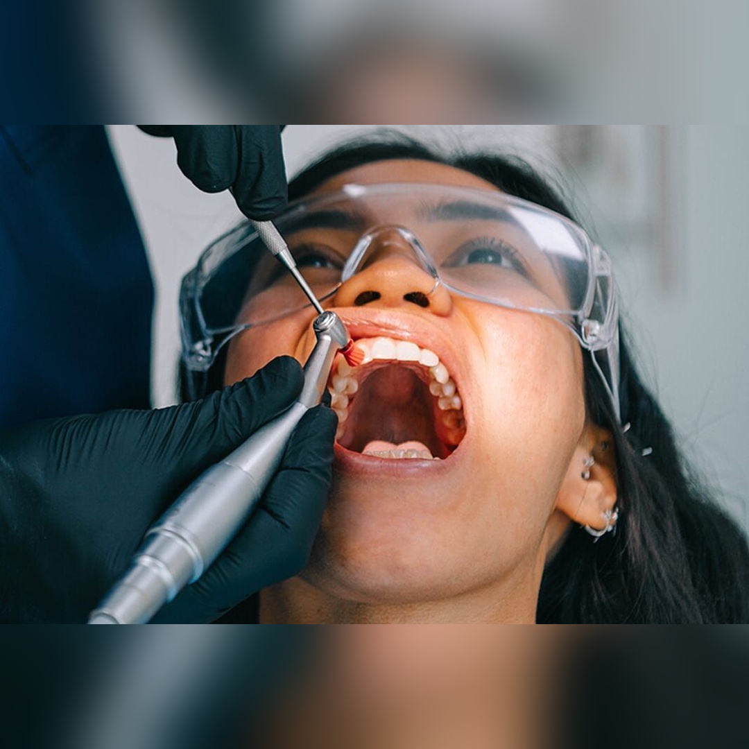 dental polishing 3_square