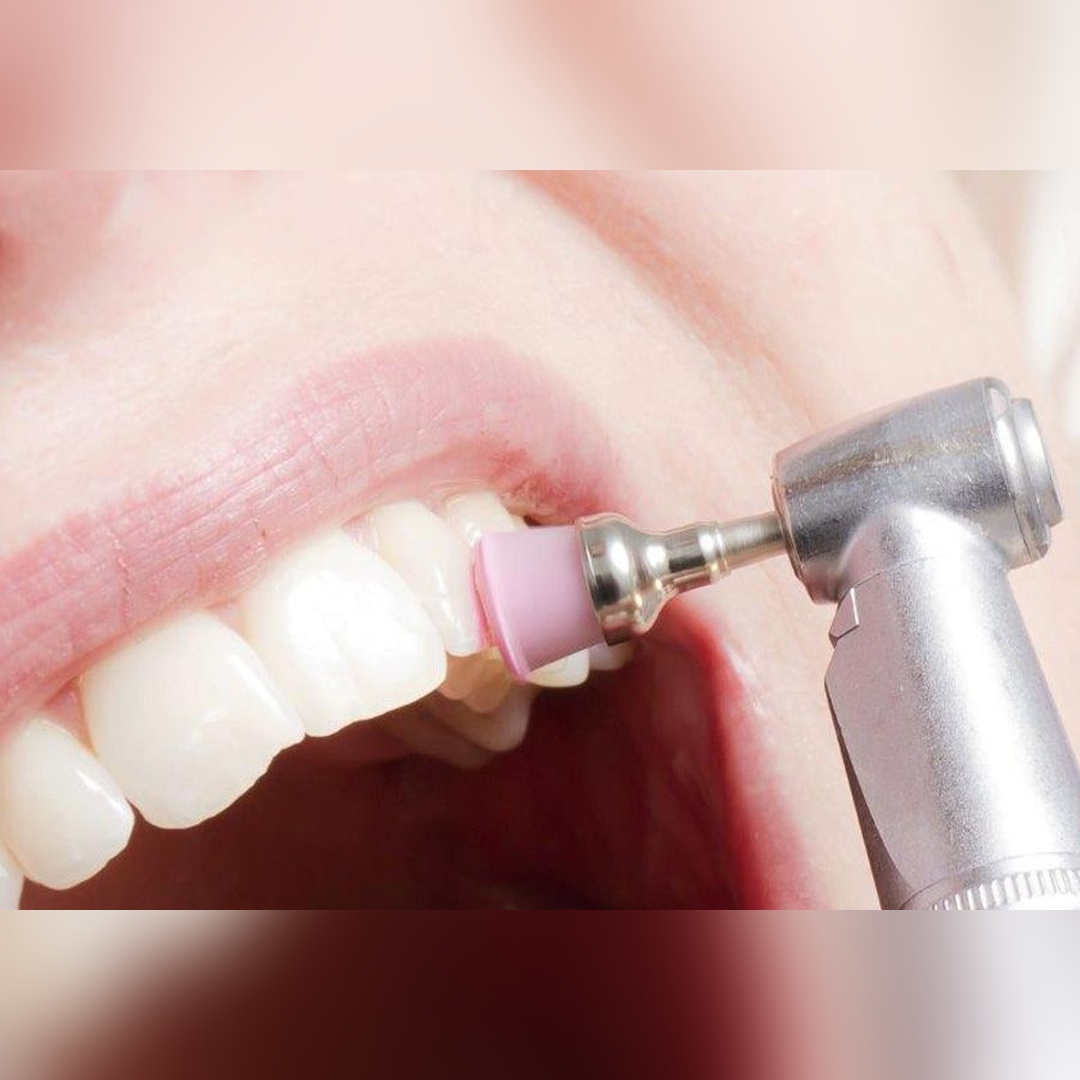 dental polishing1_square