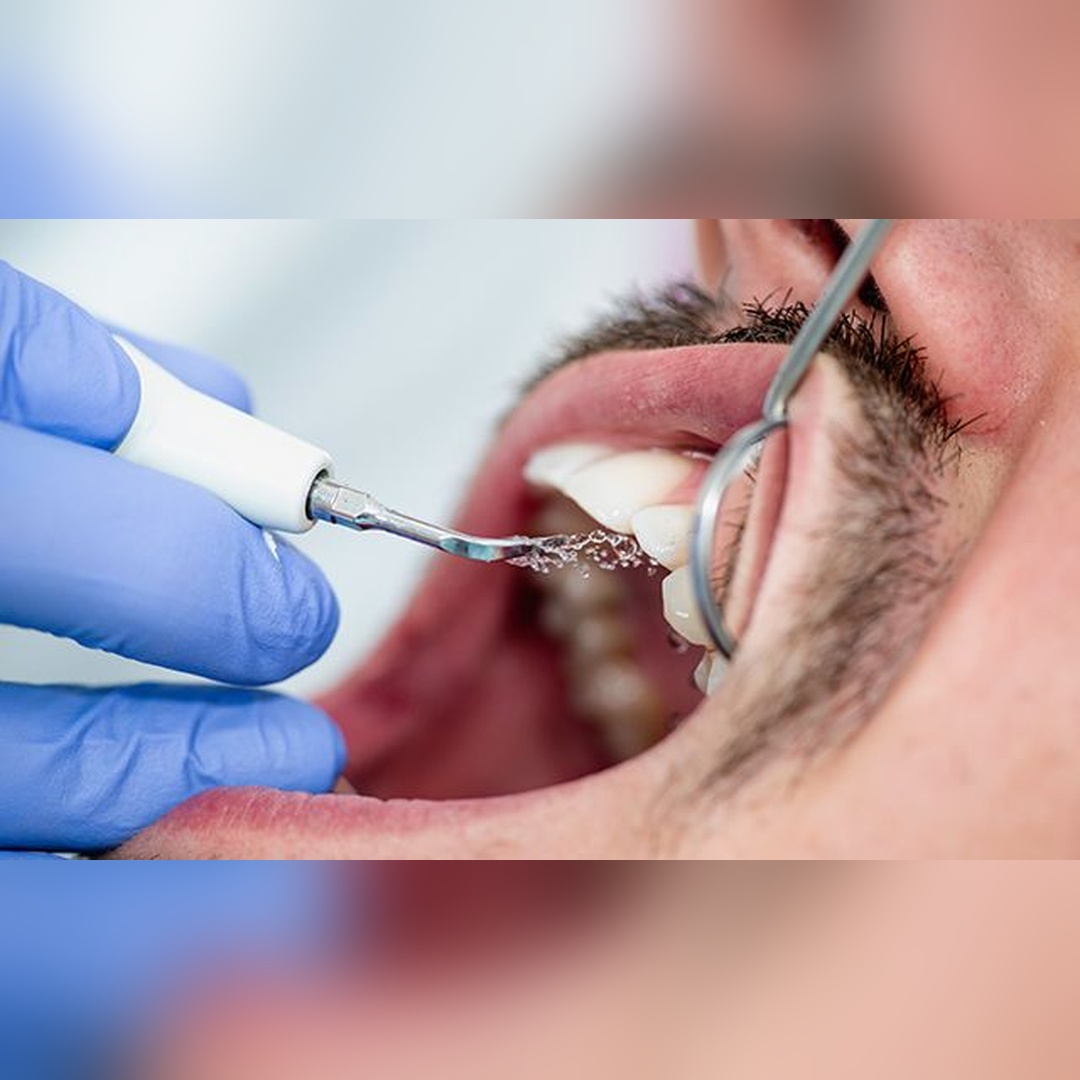 dental scaling 2_square
